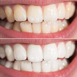 Closeup of teeth before and after cosmetic dental treatment teeth whitening