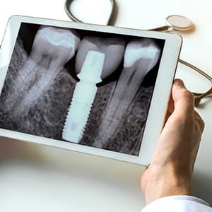 X-ray of dental implant after bone grafting in Fairfax