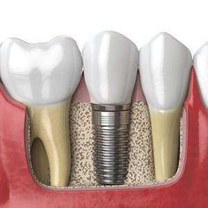 Diagram of how dental implants work in Fairfax