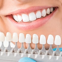 Patients smile compared with tooth color chart