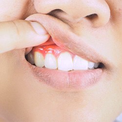 Person lifting their lip to show red, swollen gums