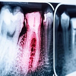Tooth x-rays before root canal therapy