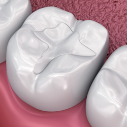 Rendering of tooth-colored filling in larger tooth