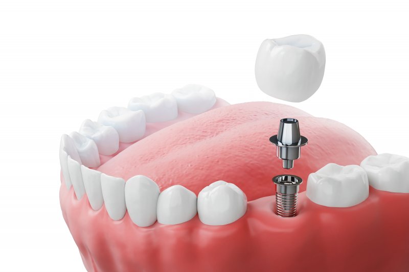 a 3D illustration of a dental implant 