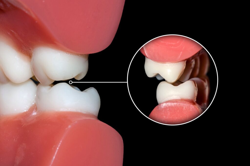 Closeup of artificial teeth grinding too closely together